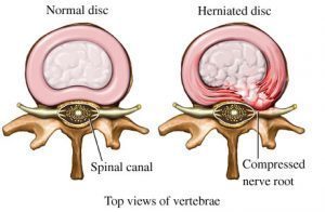 herniated disc