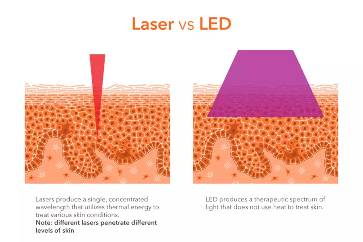 laser therapy