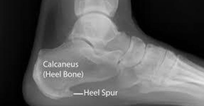 Heeling your Heel Spur