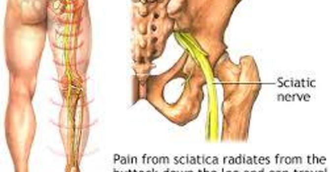 Addressing Sciatica image