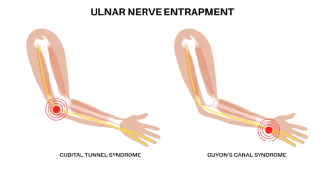 Ulnar Neuropathy image