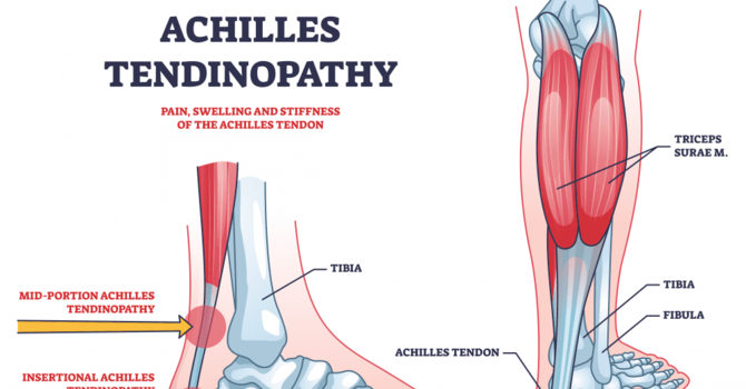 Achilles Tendinopathy: Acute and Chronic image