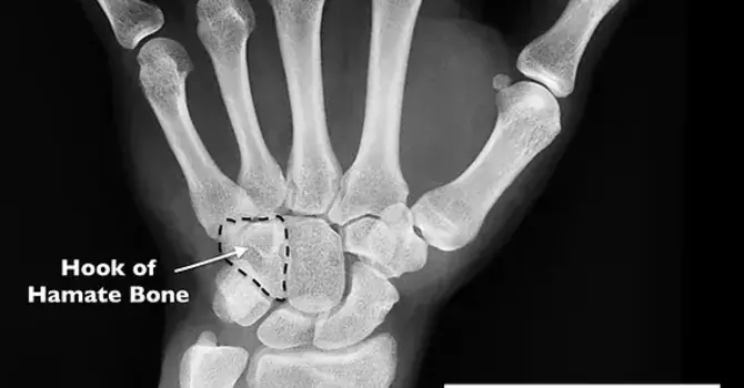 Hamate (Wrist) Fracture