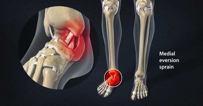 Medial Ankle Sprains