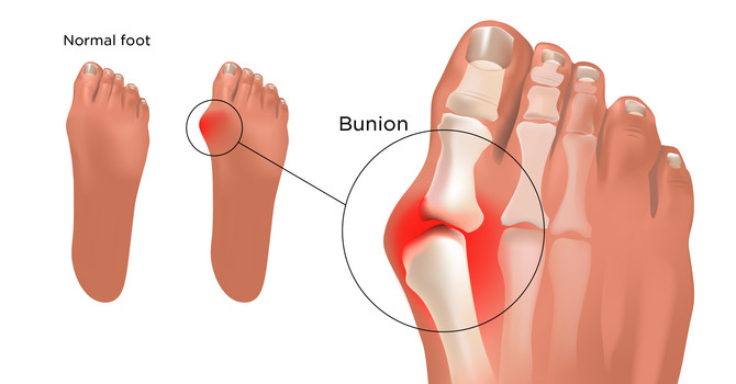 Bunions (AKA Hallus Valgus)