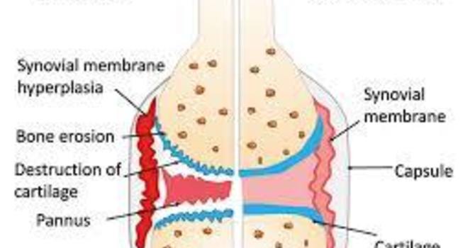 Winback Tecar Therapy for Rheumatoid Arthritis