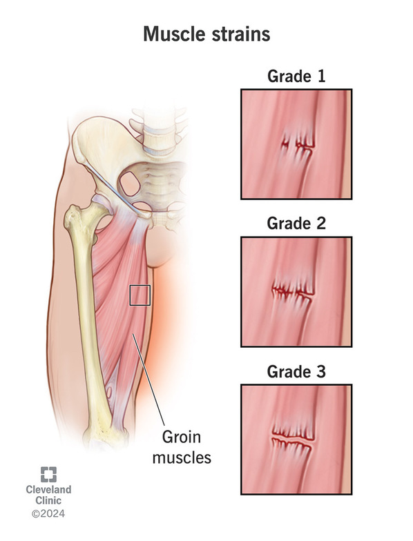 muscle strain