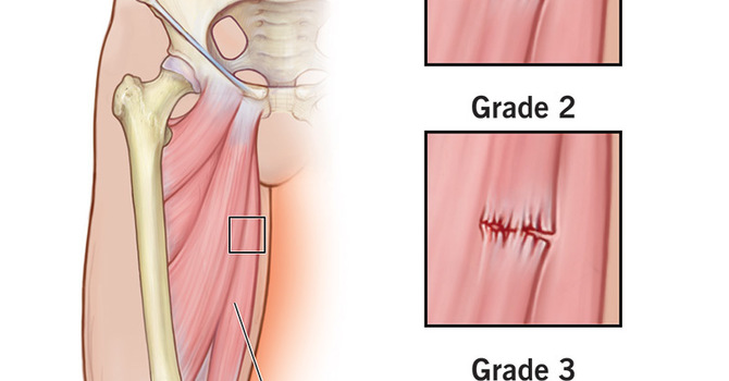 Understanding Tissue Healing in Muscular Strains: A Guide to Recovery