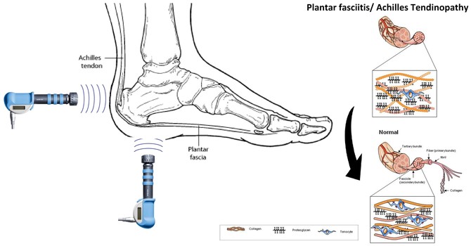 How Shockwave Therapy Helps Runners Recover Faster from Common Injuries image